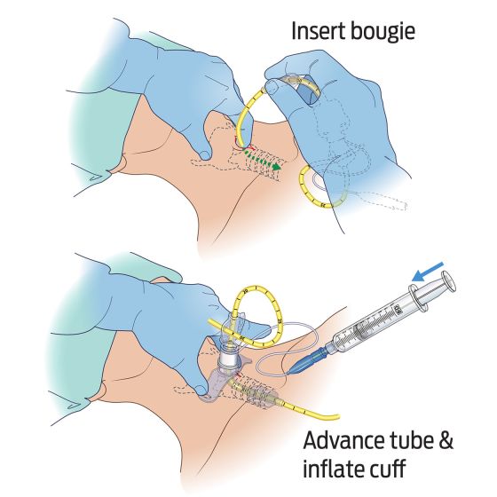 Bougie-Aided Cricothyroidotomy Pack (BAC-Pack™)