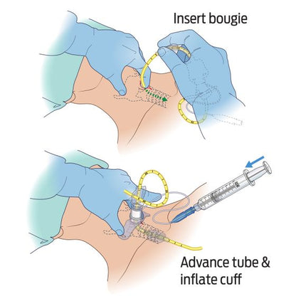 Bougie-Aided Cricothyroidotomy Pack (BAC-Pack™)