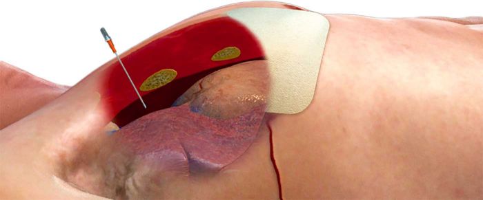 ARS for Needle Decompression (3.25 in.) image 1