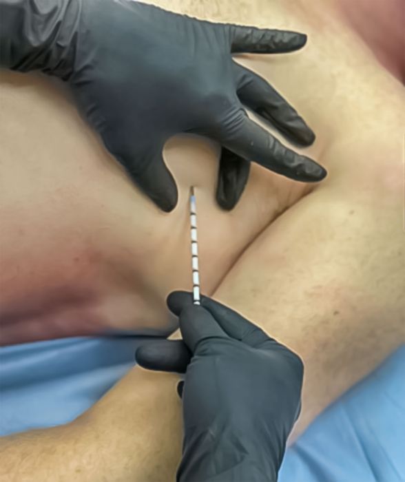 SPEAR - Simplified Pneumothorax Emergency Air Release image 2